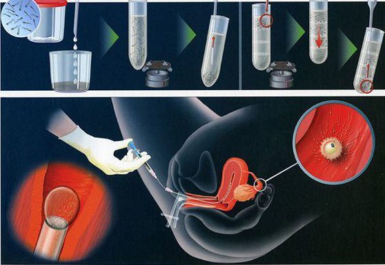 Người Công giáo có được thụ tinh nhân tạo (IVF) không?